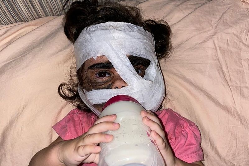 СМИ: Девочке с «маской Бэтмена» краснодарские врачи пересадили кожу с ноги на лицо